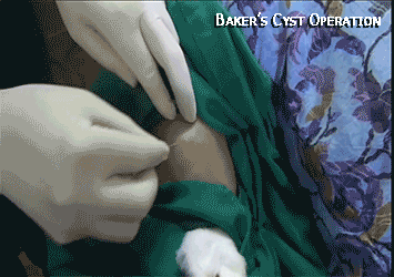 Baker's Knee Cyst Surgery Alternative B-Relief Caps INFO: bakerstreatment.com