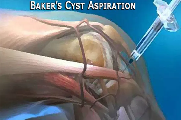 Baker Cyst Knee SURGERY Alternative